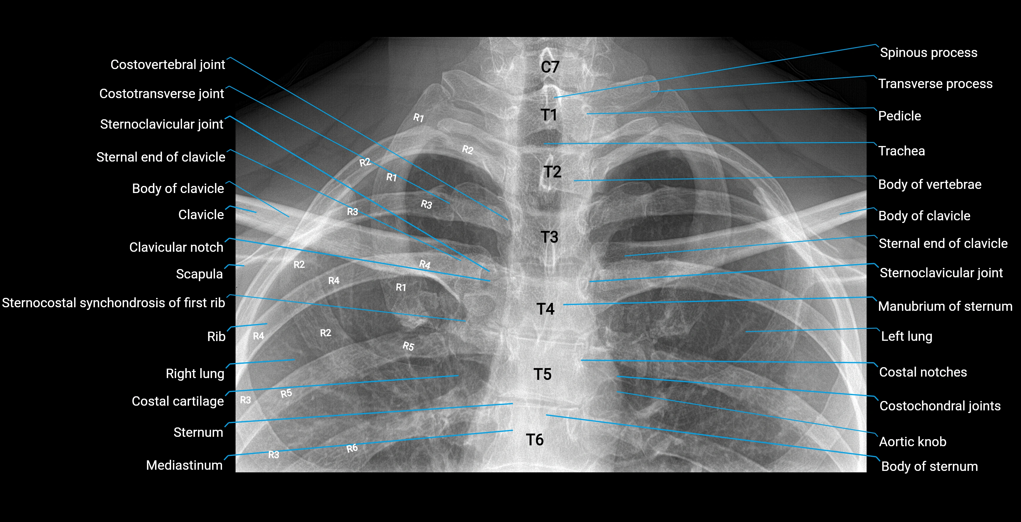 Sternoclavicular joint pa x ray  anatomy labelled image.webp